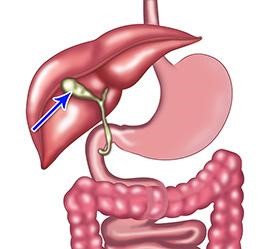 Gallstones and Gallbladder Surgery